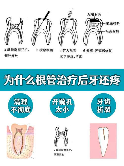 武汉根管治疗是种牙吗 别再混淆两者天差地别