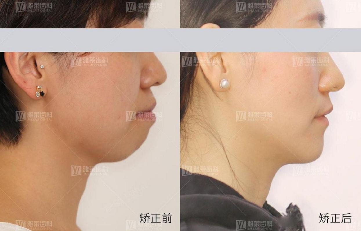 武汉矫正牙齿对脸型的改变到底有多大?真实对比告诉你