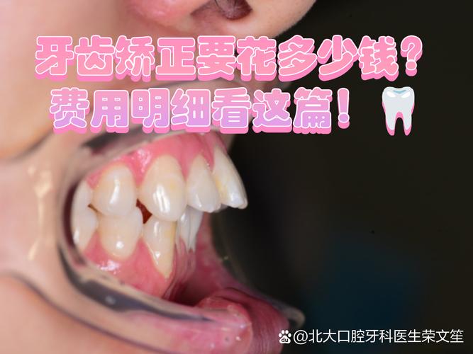 武汉广州牙齿矫正到底要花多少钱?看完这篇不踩坑