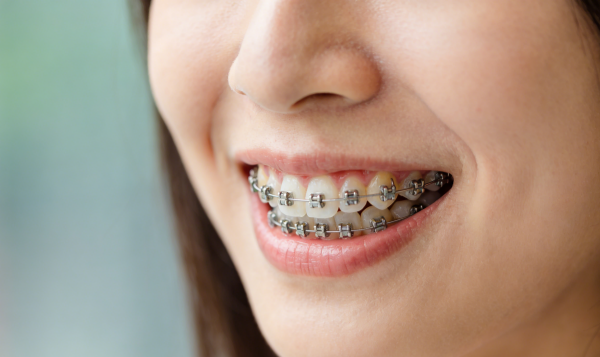 武汉牙齿矫正多久调整一次?2026复诊间隔指南+影响因素