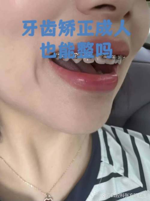 武汉成人地包天牙齿矫正 成年人还能做吗效果好吗
