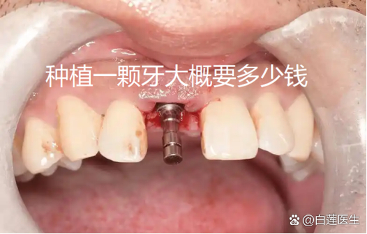武汉纯钛种牙多少钱一颗?费用明细和影响因素都在这里