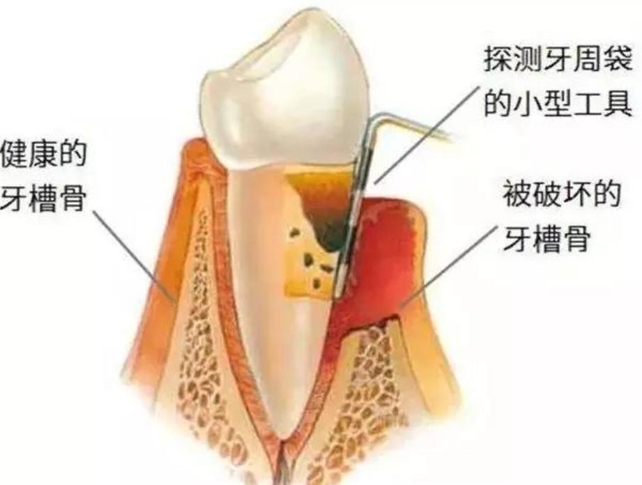 武汉深圳牙槽骨太薄种牙有救吗?医生说实话