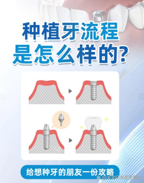 武汉上门牙种牙要多久 门牙种植美观又牢固