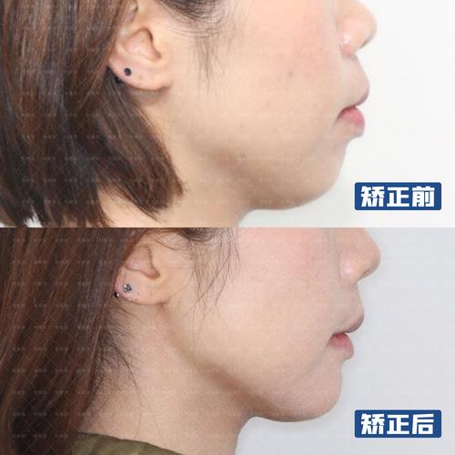 武汉35岁牙齿还能矫正吗 成人矫正效果看这里
