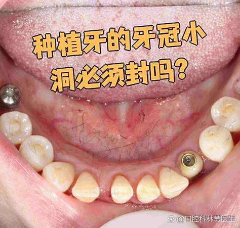 武汉深圳龙华全口种植牙当天戴牙冠，靠谱吗？