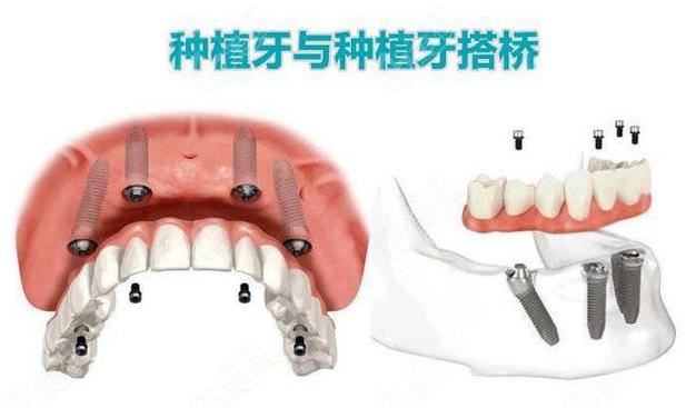 武汉种植牙还是搭桥哪个更好
