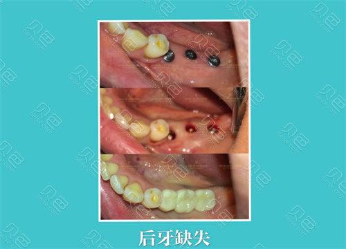 武汉龙岗中心城种植牙医院怎么选 本地人的真实推荐