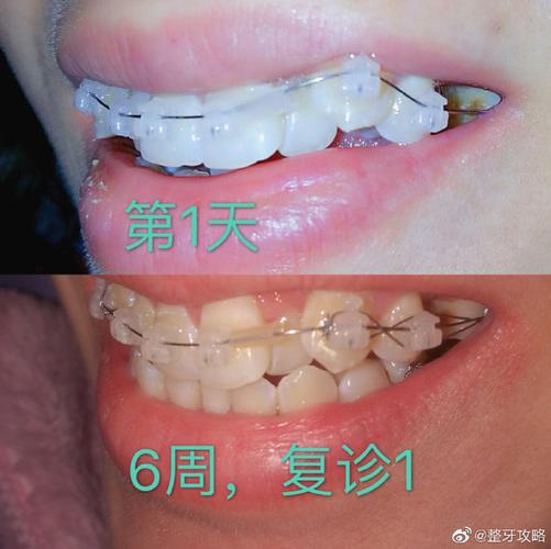 武汉深圳牙缝过大矫正多少钱 价格表一览