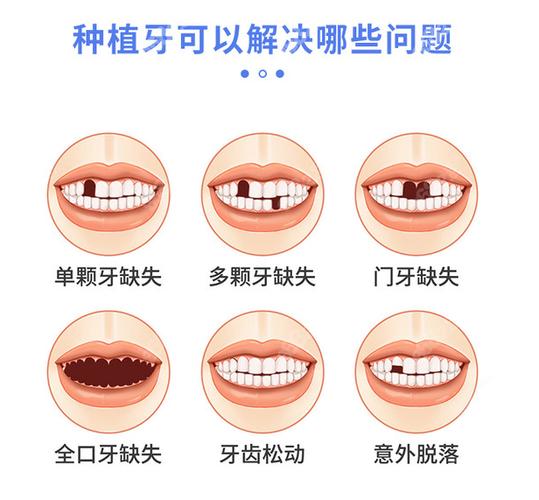 武汉宝安新安种植牙哪家医院好?靠谱选择看这几点