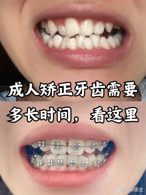武汉41岁做牙齿矫正晚不晚?成人正畸真实经历分享