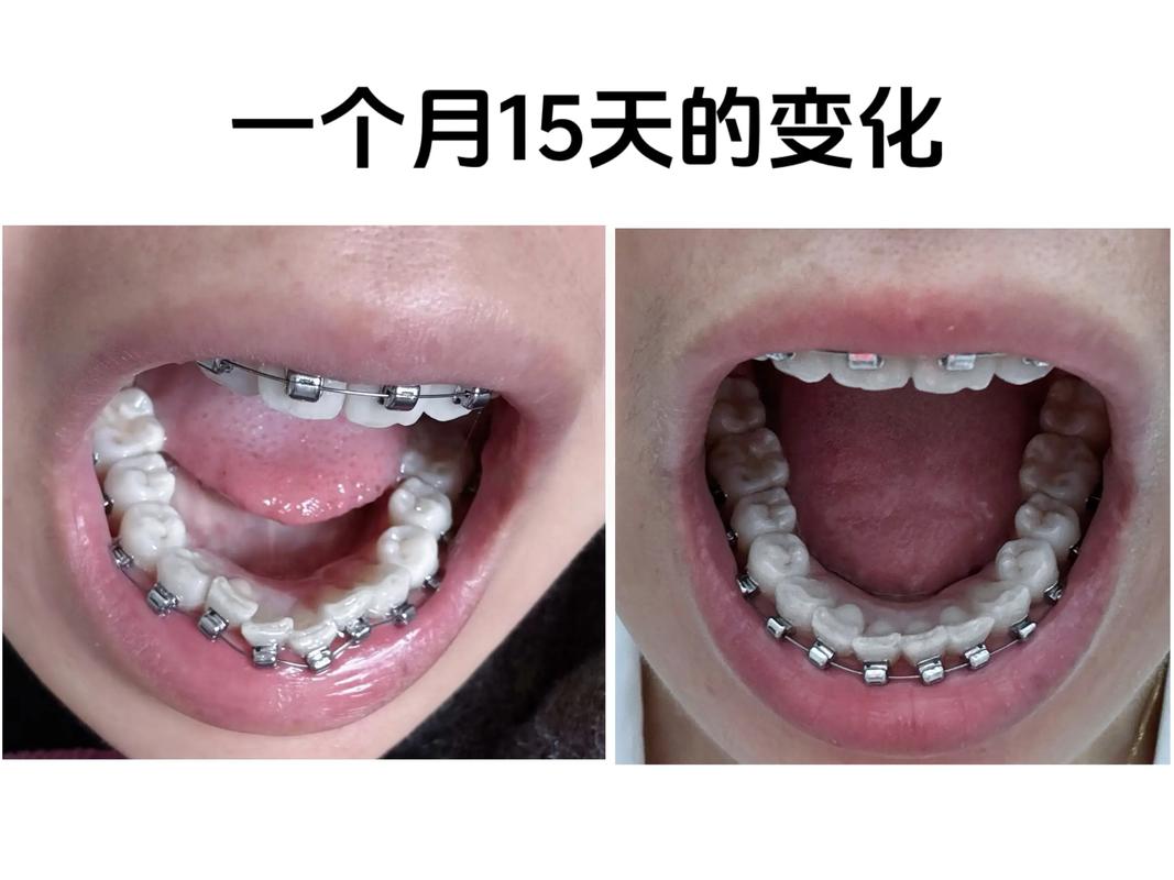 武汉矫正牙齿的黄金年龄是几岁 成人矫正晚不晚