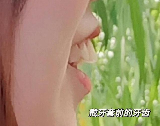 武汉深圳骨性龅牙正畸选哪家医院?骨科正畸避坑全攻略