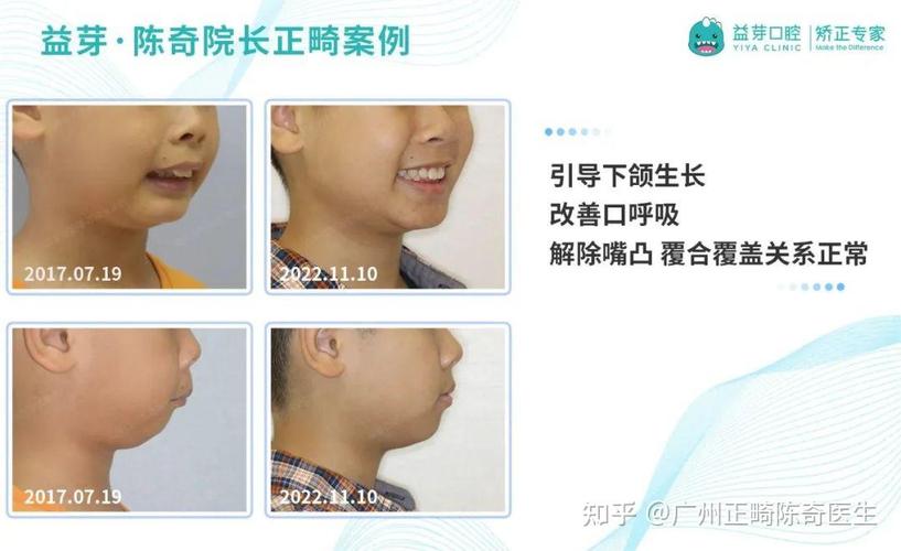 武汉东莞儿童牙齿矫正几岁开始最好?家长别等换完牙才后悔