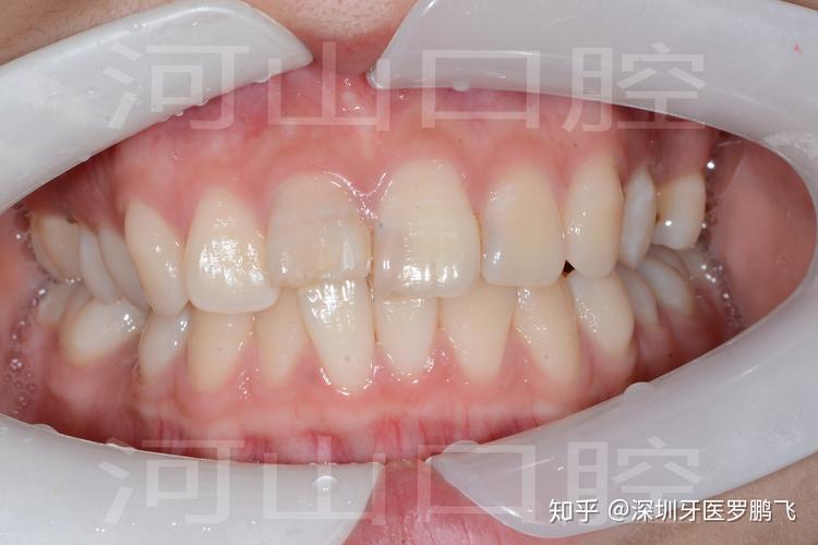 武汉20岁牙齿还能不能矫正?成年人正畸真实情况揭秘