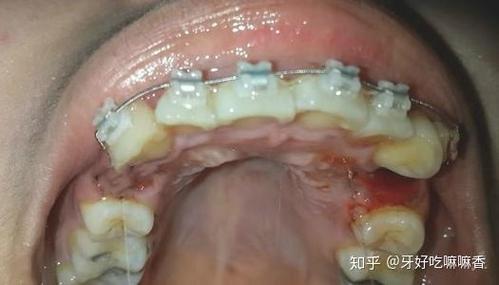 武汉宁波青少年牙齿矫正选哪家?费用多少?看完这篇就明白