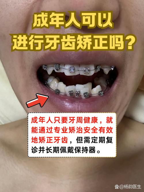 武汉30岁矫正牙齿还来得及吗 成年人正畸必看