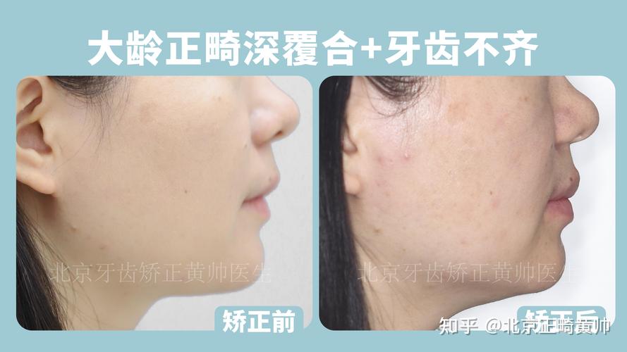 武汉45岁做深覆合矫正大概多少钱?费用明细全公开