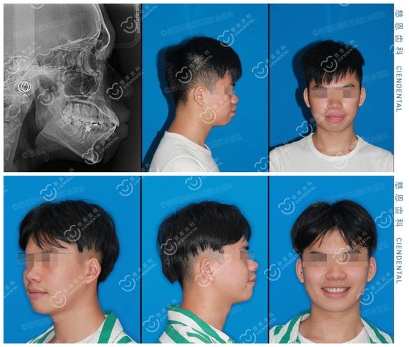武汉深圳罗湖骨性龅牙隐形矫正能行吗?方案详解