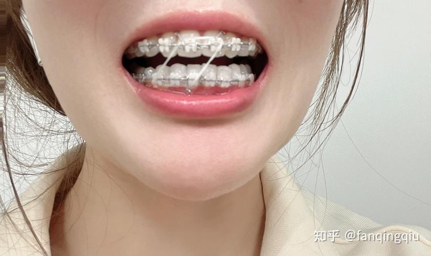 武汉27岁做牙齿矫正还来得及吗