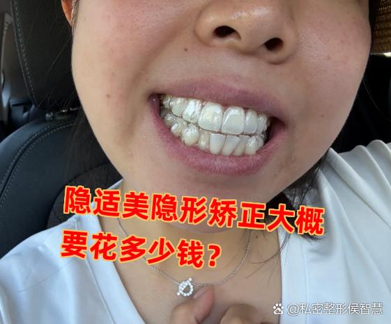 武汉深圳龙岗隐适美牙套多少钱?收费明细看这篇
