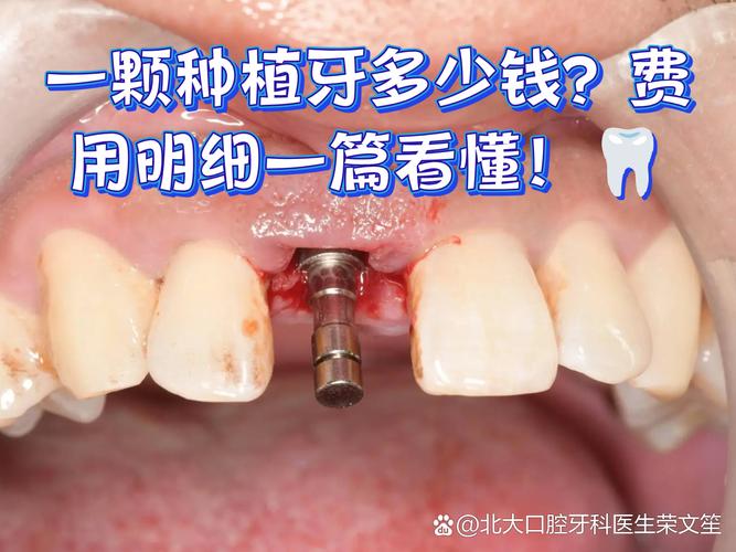 武汉深圳种牙贵不贵?揭秘诺贝尔种植牙门诊真实收费明细