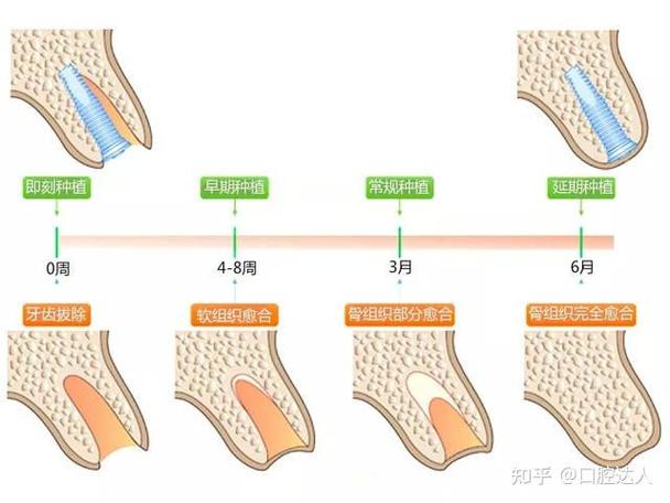 武汉掉3颗牙怎样种植?种牙流程全解析+费用避坑指南