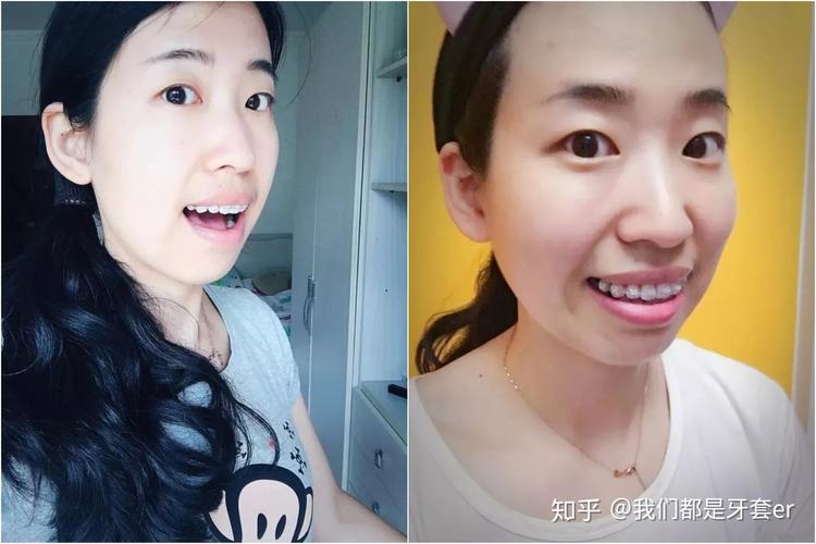 武汉30岁做牙齿矫正晚不晚?真实情况告诉你