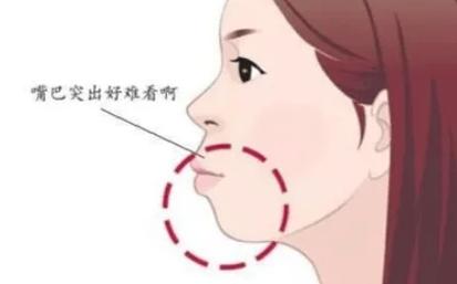 武汉正颌手术前必读:矫正牙齿正颌全过程详解