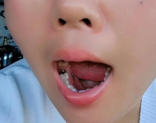 武汉55岁种牙好还是镶牙好?一文告诉你答案