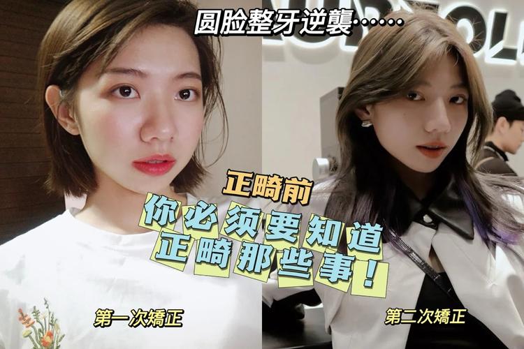 武汉23岁整牙还来得及吗?过来人说实话