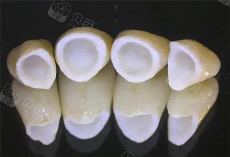 武汉深圳做全瓷牙到底要花多少钱?2026年最新报价揭秘