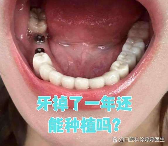 武汉牙齿掉了还能种吗？现在种牙靠谱不靠谱