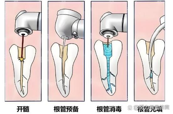 武汉种牙要等多久 最佳种牙时间全知道