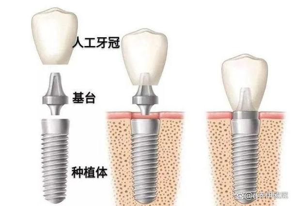 武汉集采种牙和自费种牙到底差在哪