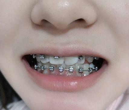 武汉30岁做牙齿矫正有什么后遗症?看完这篇不踩坑