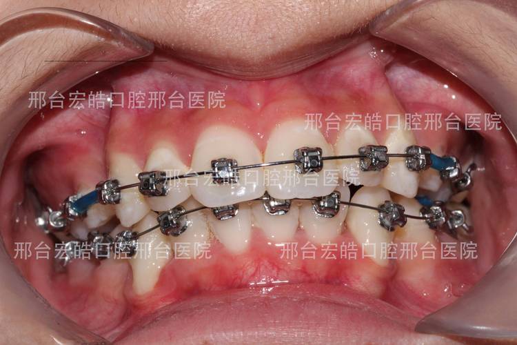 武汉不整齐牙齿矫正到底要花多少钱？大概多久能好？
