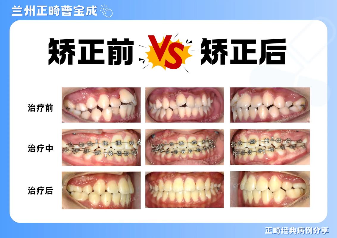 武汉35岁做牙齿正畸晚吗?成人矫正前先看这3点