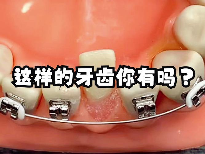 武汉8岁小孩牙齿歪了能矫正吗 家长别错过最佳时机