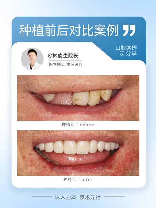 武汉深圳坪山种一颗牙多少钱 价格明细来了