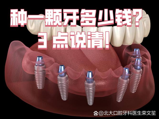 武汉沈阳种牙2026年单颗多少钱?3000到5200元能搞定吗