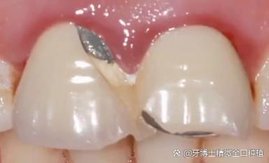 儿童牙发白就像白斑_孩子牙齿发白怎么办_小孩牙齿发白能自愈吗