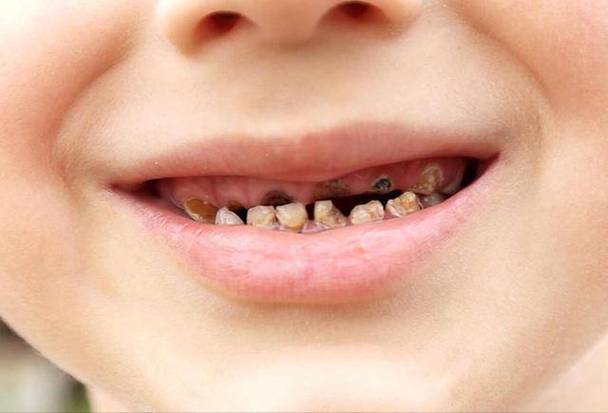 儿童牙发白就像白斑_孩子牙齿发白怎么办_小孩牙齿发白能自愈吗