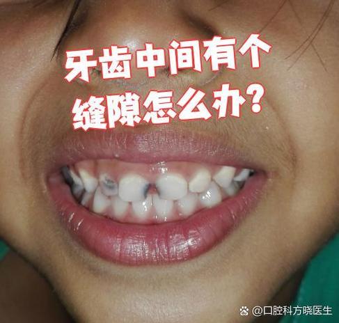 武汉门牙有缝怎么矫正？这几种方法亲测有效