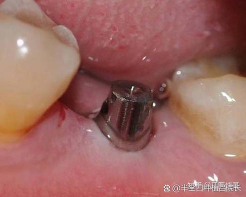 武汉65岁老人牙齿还能种吗?种牙靠谱吗