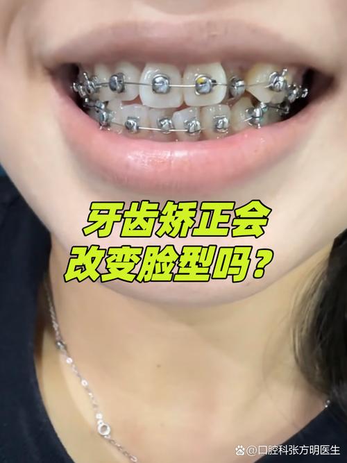 武汉18岁龅牙能矫正吗 成人正畸看这篇就够