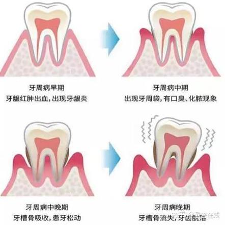 武汉三十岁还能整牙吗?成人牙齿矫正必知真相