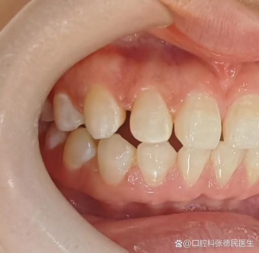 武汉深圳牙缝过大矫正多少钱?最新价格一览
