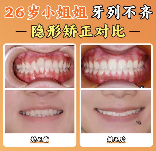 武汉北京舌侧矫正靠谱吗?价格/医院/医生全揭秘