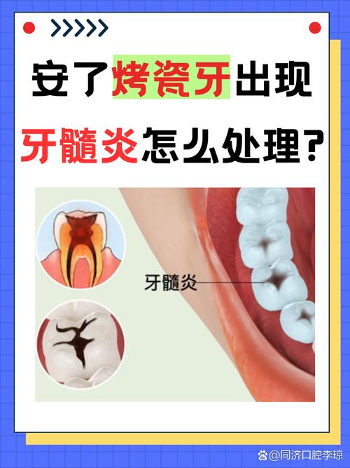武汉牙医良心忠告:做烤瓷牙前这两点不注意,当心毁了整口牙
